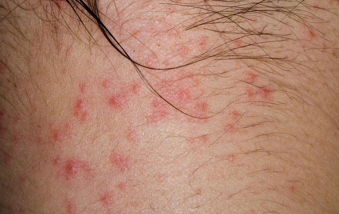 Curious about atopic dermatitis? Here’s what you need to know