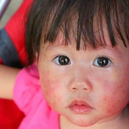 Skin Rashes – Common Types and Causes