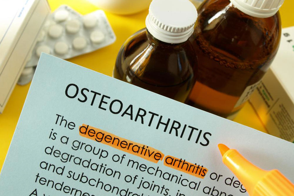 Osteoarthritis – How to Treat it