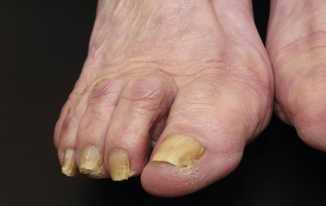 Try These Natural Methods to Cure Nail Fungus