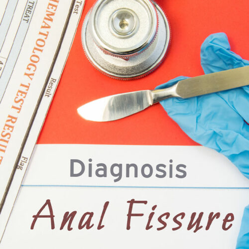 Anal Fissures – Its Causes, Symptoms, and Management
