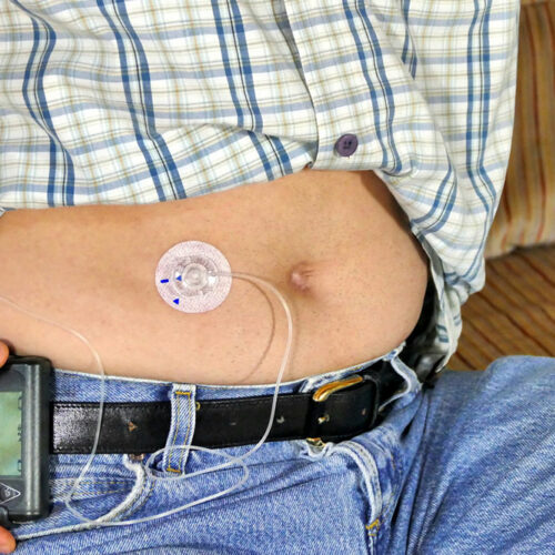 Insulin Pumps for Type 1 Diabetes – Types and Benefits