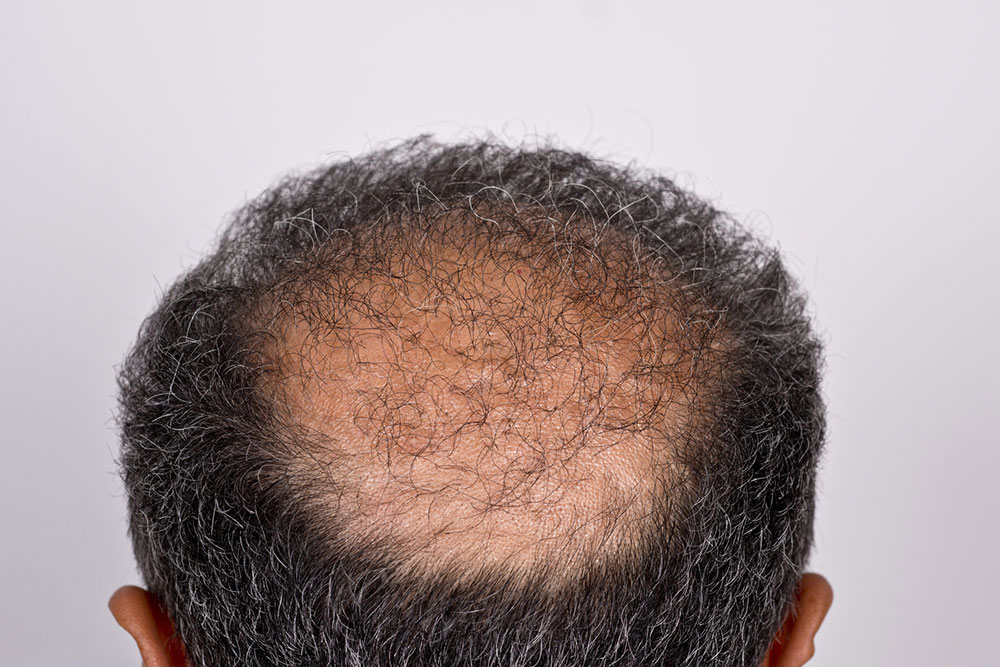 Hair Transplant – Types, Procedure, and Cost